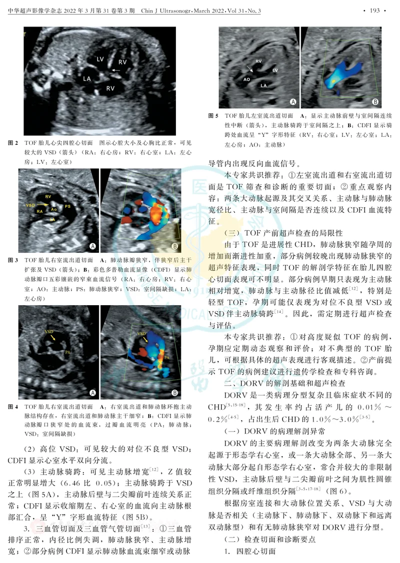 胎儿法洛四联症和右室双出口超声检查中国专家共识(2022版)
