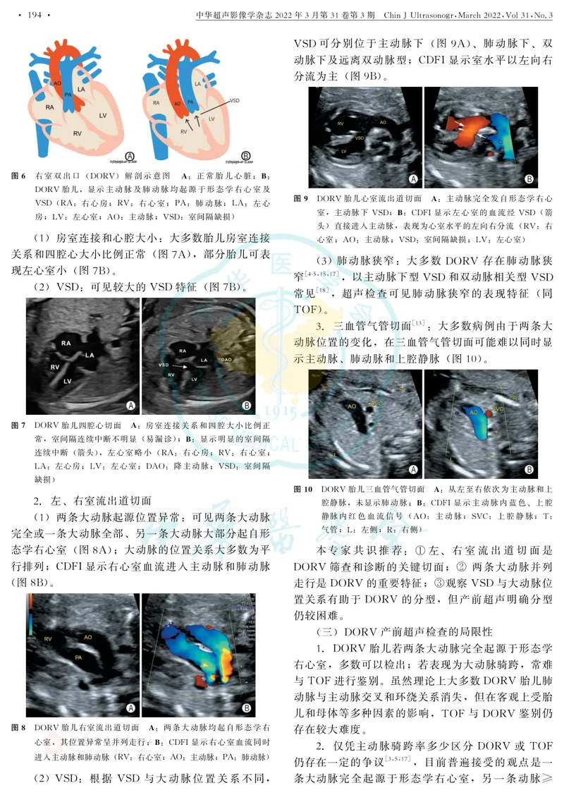 胎儿法洛四联症和右室双出口超声检查中国专家共识(2022版)