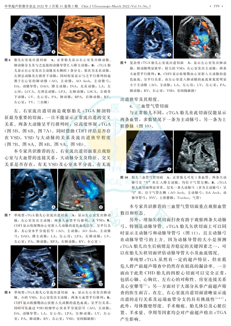 胎儿完全型大动脉转位中孕期超声检查中国专家共识(2022版)
