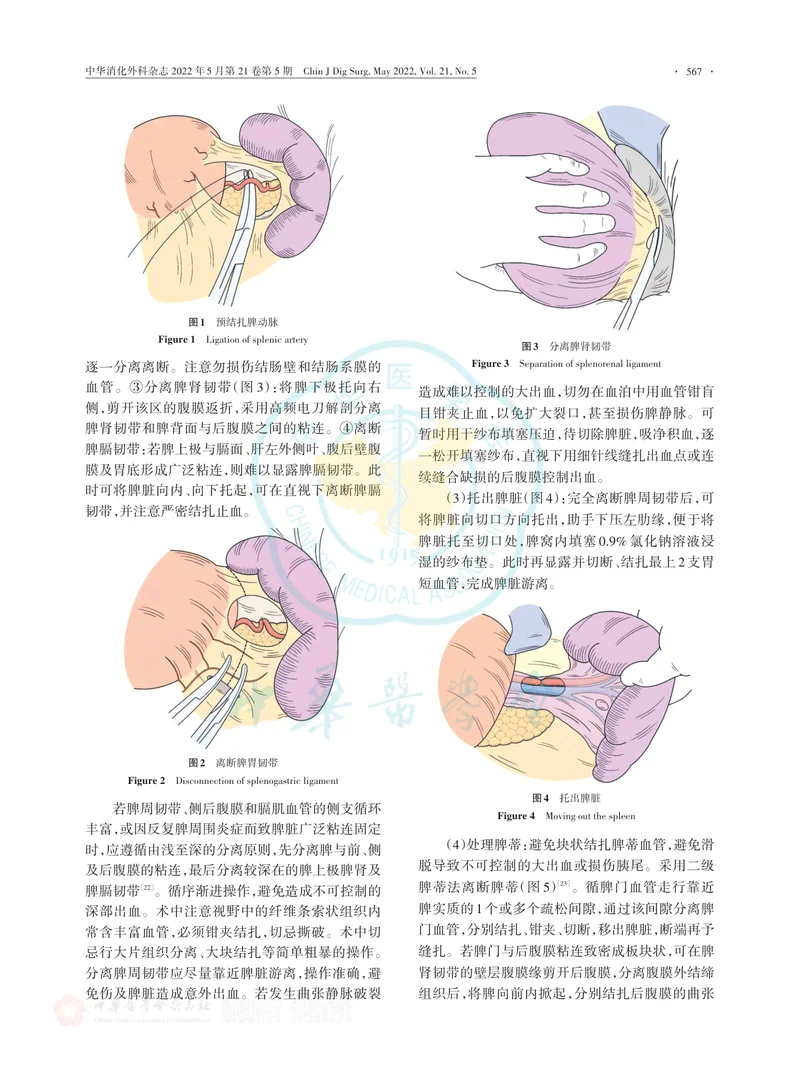 开腹贲门周围血管离断术中国专家共识（2022版）