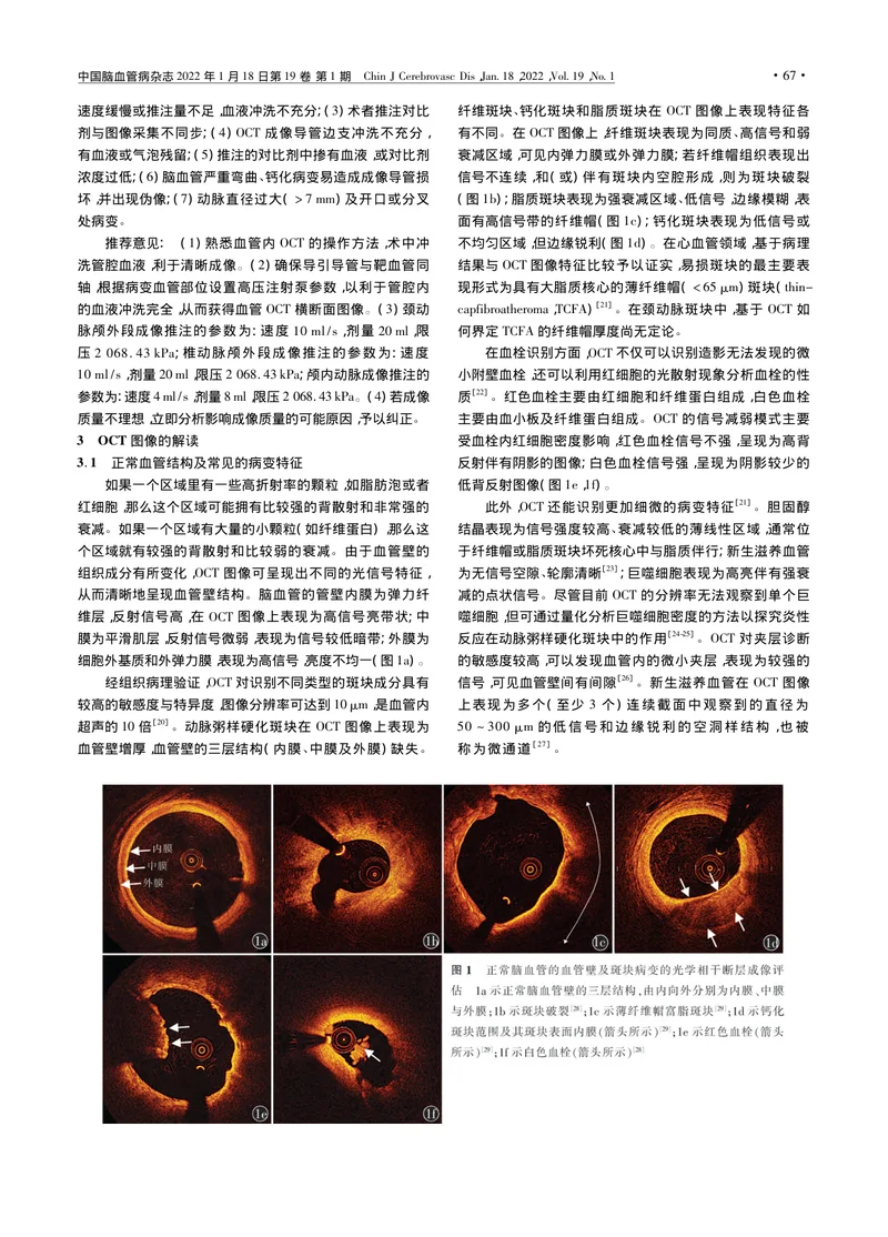 中国光学相干断层成像技术在缺血性脑血管病介入诊疗中的应用专家建议（2022）