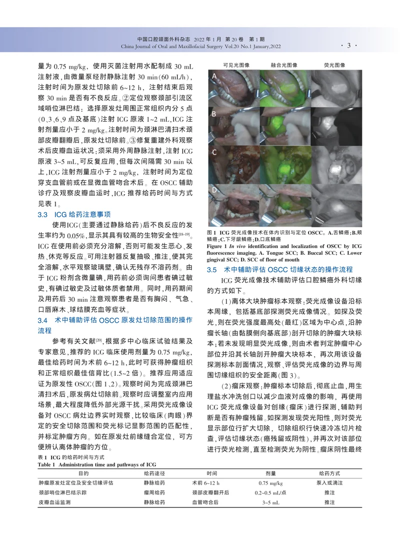 吲哚菁绿荧光成像技术在口腔鳞癌治疗中的应用：中国专家共识（2022）