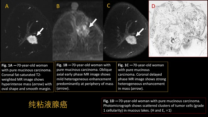 乳腺粘液腺癌MR与病理特点
