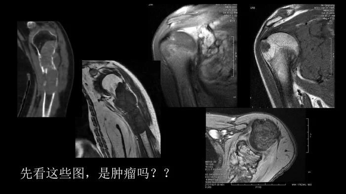 影像诊断学习与扩展：代谢性骨病(病例23)